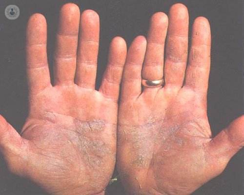 psoriasis-codo-jpg